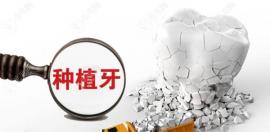 2025种植牙收费项目有哪些?有种植体,牙冠,医疗服务(附价格)