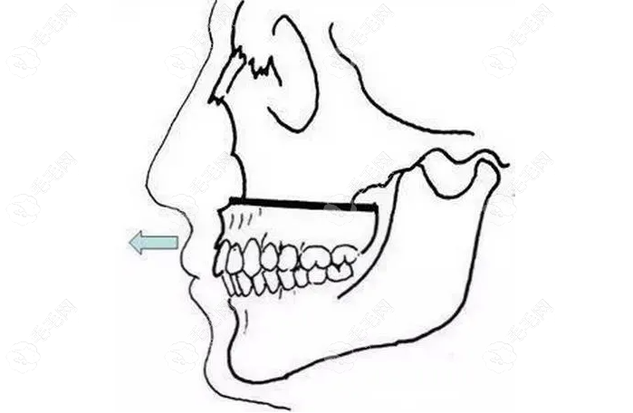 掩饰性矫正地包天不如正颌有效