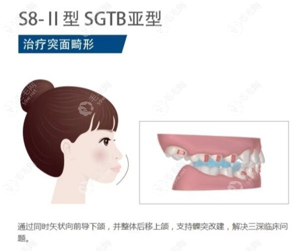  掩饰性矫正后还可以正颌吗