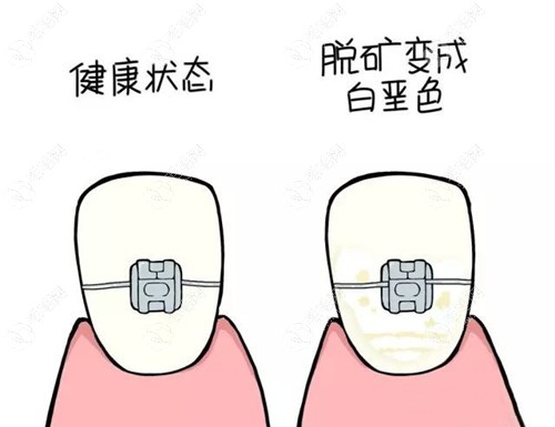 国产自锁托槽和进口自锁托槽差别