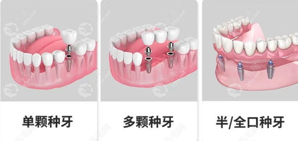 淄博种牙要多少费用