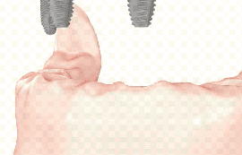 淄博种植牙集采新消息公布:纳入集采后种一颗牙2k+/全口牙6w+