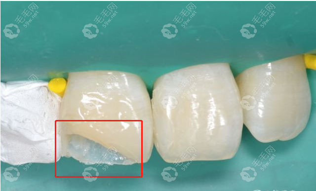 牙齿表面的牙釉质掉了能修复吗