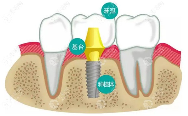 为什么私立口腔医院种植牙便宜?价格差别在收费机制/折扣上