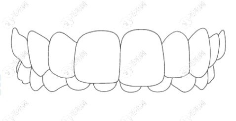 深覆合矫正牙齿大概多少钱?4-8k儿童和成人轻微深覆合有价差