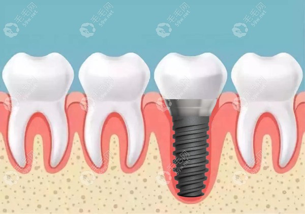 常规种植牙医疗服务费59w.net