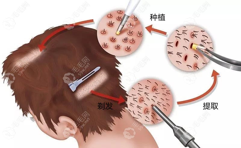 金华植发发际线费用