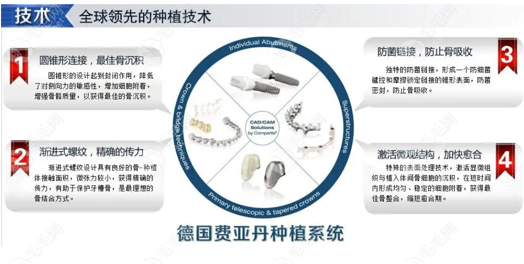 德国费亚丹种植牙价格：10800-15000元左右一颗