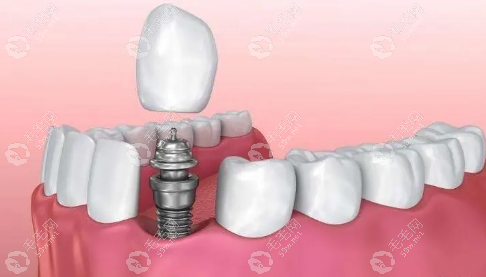 2023泉州种植牙价格已经下降,种单颗牙2980+/半口2w+/全口牙5w起