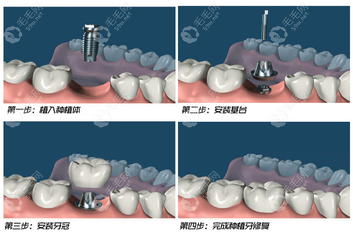 即刻种植牙优点是什么?当天能用/节省时间/减少创伤等优势