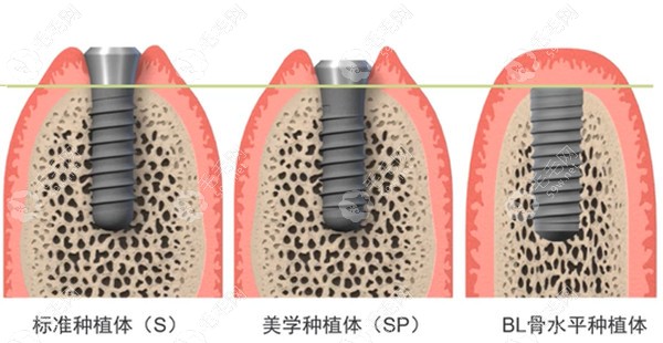 绍兴柯桥种植牙一颗多少钱？3000元起一颗