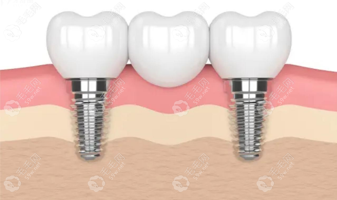 2023种植牙多少钱一颗毛毛网