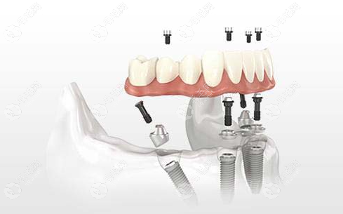 南阳全口种植牙要多少钱59w.net