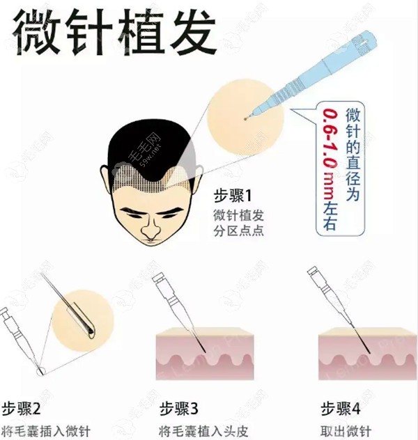 呼和浩特沐森植发技术