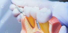 银川口腔医院收费标准新版:集采后种植牙价格3k+/牙齿矫正8k+