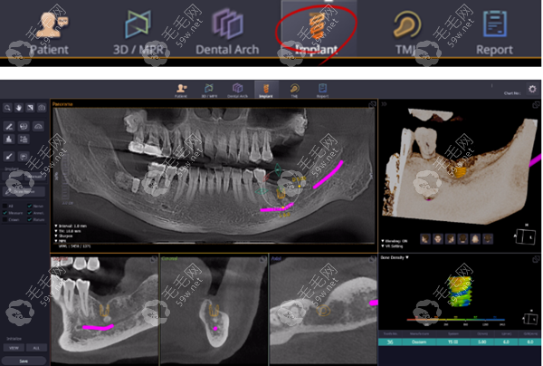 CBCT种植牙影像 59w.net