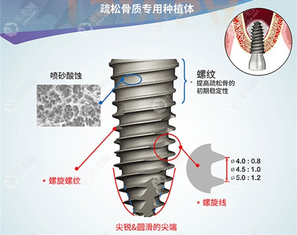 ET SA型号种植体可在植入过程调节植入位置