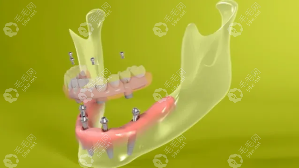 深圳半全口种植牙多少钱,半固定种植牙3w+/all-on-4种全口牙5w+