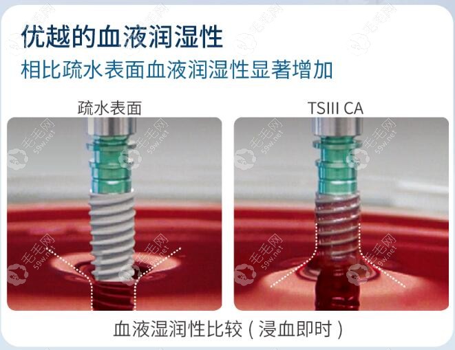 TSIII CA型号种植体的优势