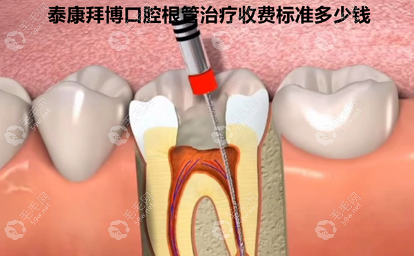 泰康拜博口腔根管治疗收费标准多少钱?根管治疗费用300-2300?