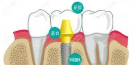 徐州种植牙多少钱一颗?2023年集采开始后种一颗牙价格不过万