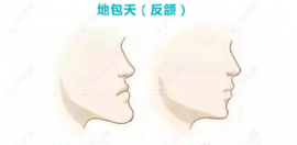 地包天矫正是上牙外移还是下牙内移?矫正后地包天会反弹吗