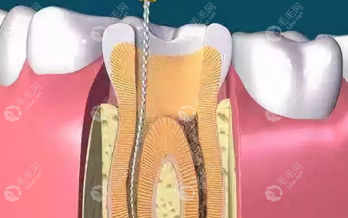 无锡口腔医院牙齿根管价格：350-2000元左右一颗