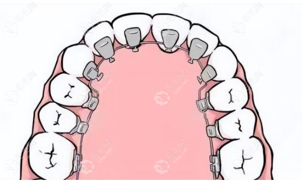 牙齿矫正方法 毛毛网
