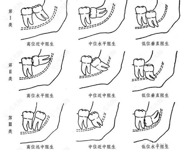 邯郸口腔医院拔智齿价格：400-2000元左右一颗