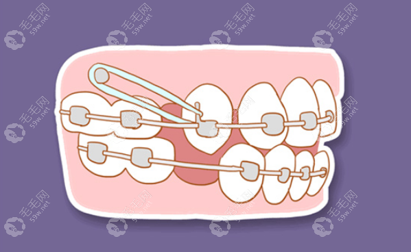 牙齿正畸特色毛毛网