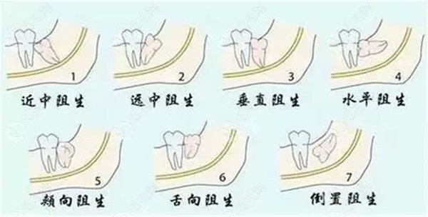 公办医院拔阻生智齿收费标准