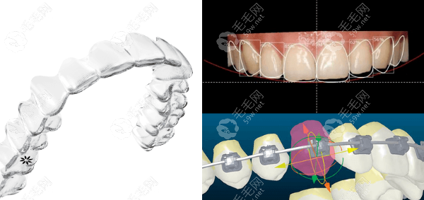 数字化正畸和传统正畸的区别在哪？