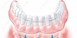 种植牙马龙桥价格公示:半口马龙桥5w+/全口种植牙马龙桥8-15w