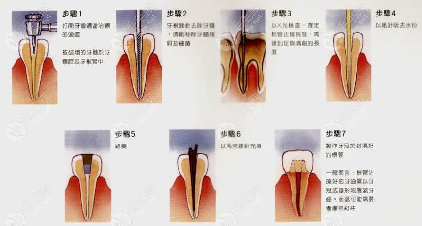 根管治疗三次费用分别多少