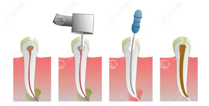 根管治疗一颗全部费用59w.net