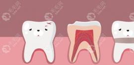 牙齿根管治疗费用一般多少钱一颗?根管治疗三次下来500-2000
