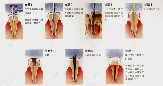 牙髓如果还活着千万别做根管治疗