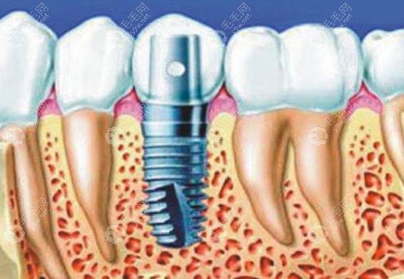 口腔医院种植牙的价格一般多少 毛毛网