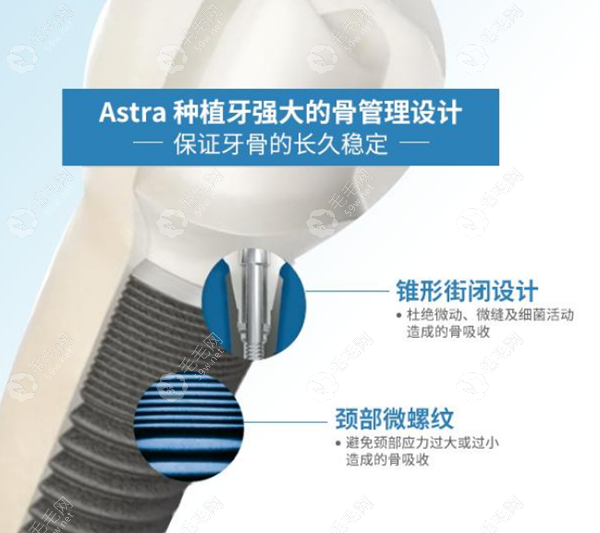 astra种植体价格59w.net