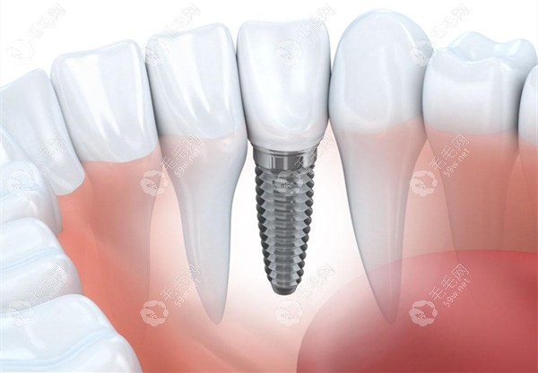 济南口腔医院国产种植牙费用