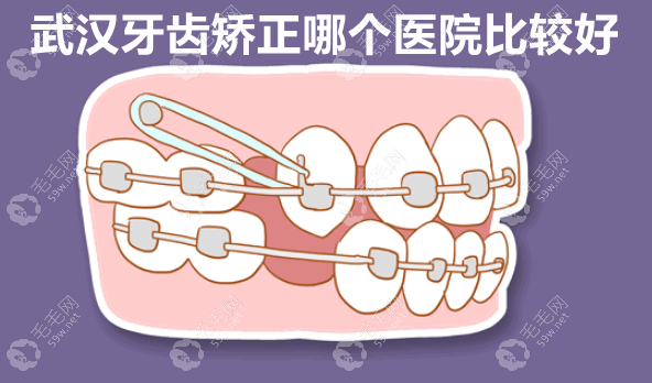 武汉牙齿矫正哪个医院比较好 59w.net