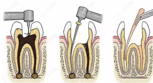 根管治疗手术过程 