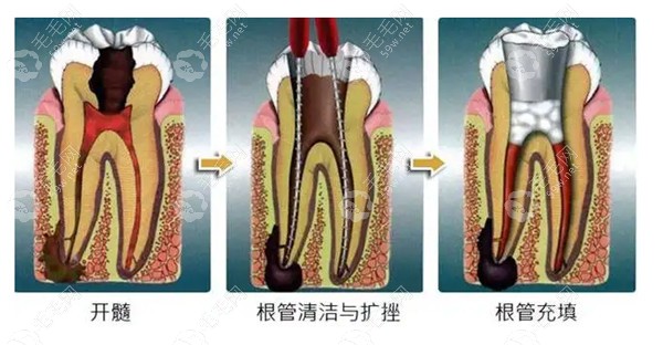 徐州牙科根管治疗价格专区