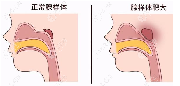 13岁腺样体肥大牙齿矫正能改善吗?可以,矫正费用也一并给你