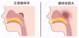 13岁腺样体肥大牙齿矫正能改善吗?可以,矫正费用也一并给你