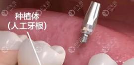 種植牙后我天天吸煙植體差點(diǎn)脫落,告誡大家種完牙不要吸煙