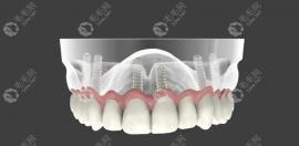 做全口种植牙后悔了怎么办?亲身经历有异物感非常难受,想取
