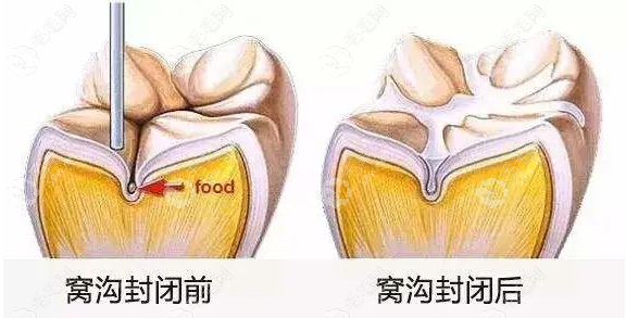 六龄齿窝沟封闭不是长一颗做一颗