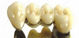 钴铬烤瓷牙一般多少钱?日常价格600-800起/200-400元一颗不贵但.
