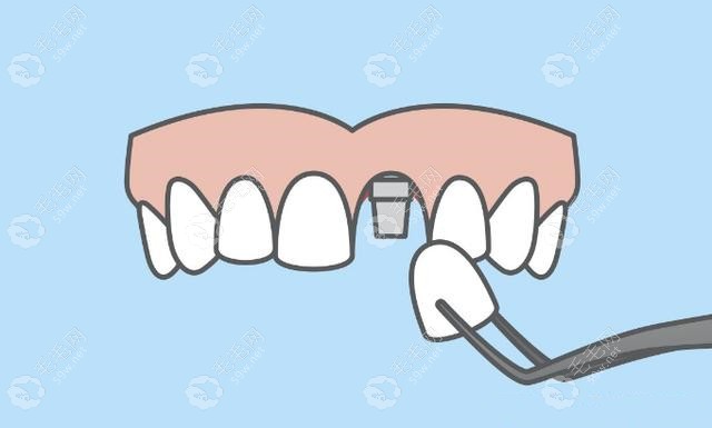 种植的牙齿和真的牙齿一样的感觉